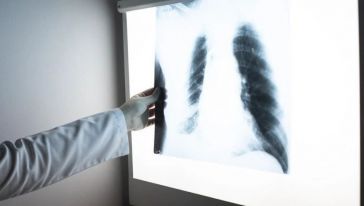Erkeklerde 'Akciğer Kanseri', Kadınlarda 'Meme Kanseri' Başı Çekiyor