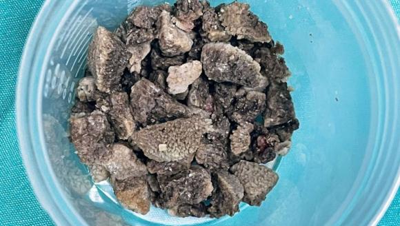 Şiddetli Sancı İle Acile Gitti.. 8 Santimetre Çapında Taş Çıktı!..